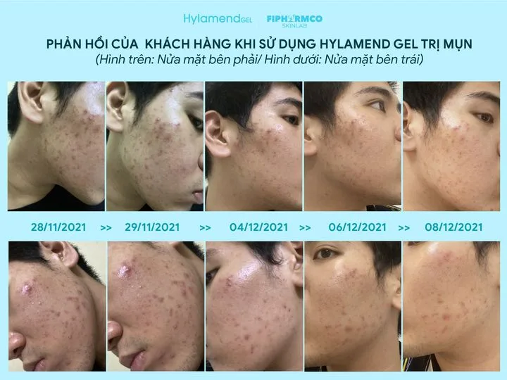 Gel Giảm Mụn & Hỗ Trợ Bảo Vệ Da Hylamend