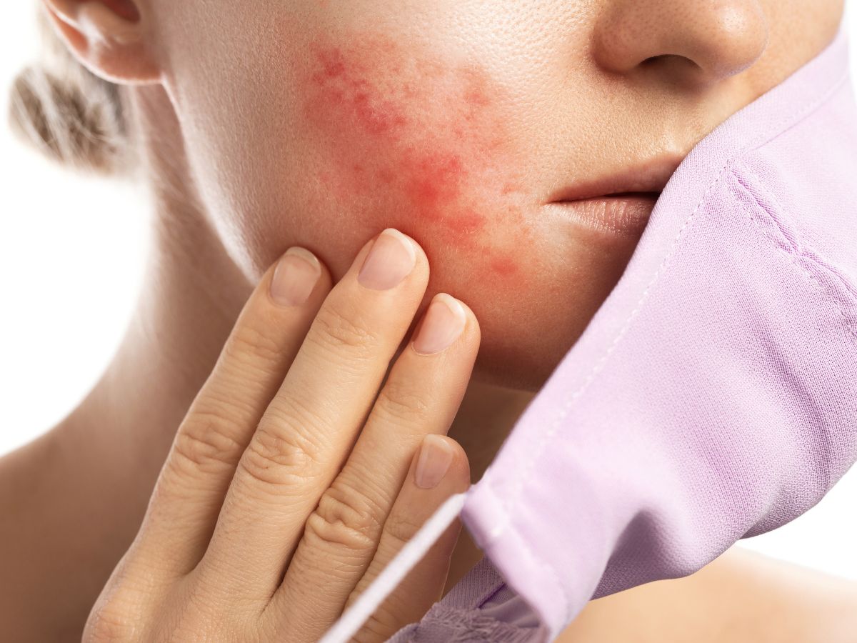 deo-khau-trang-bi-mun