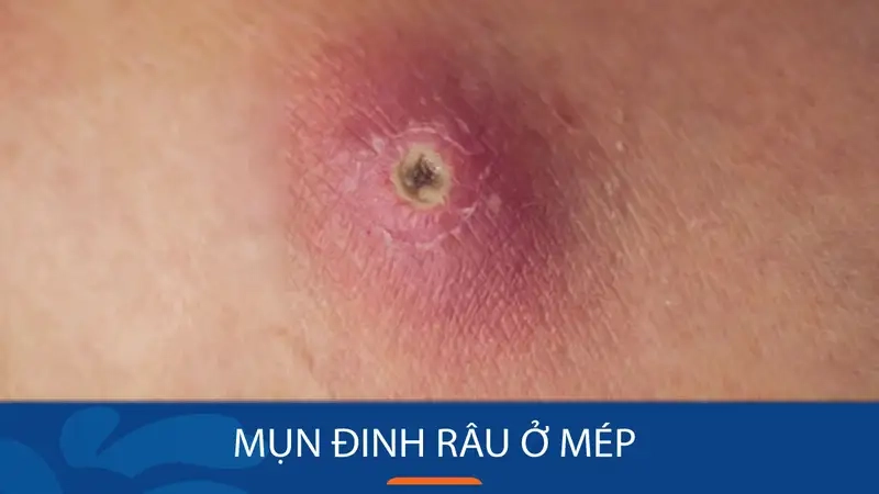 dau-hieu-nhan-biet-mun-dinh-rau