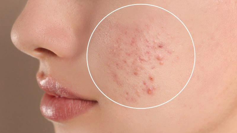 hang-rao-bao-ve-da-suy-yeu-gay-noi-mun