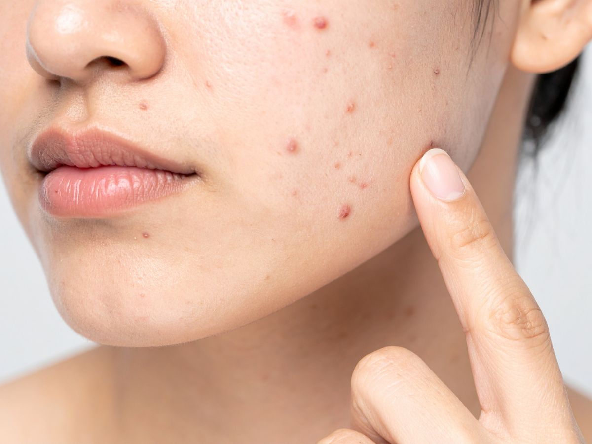 cach tri mun viem o ma